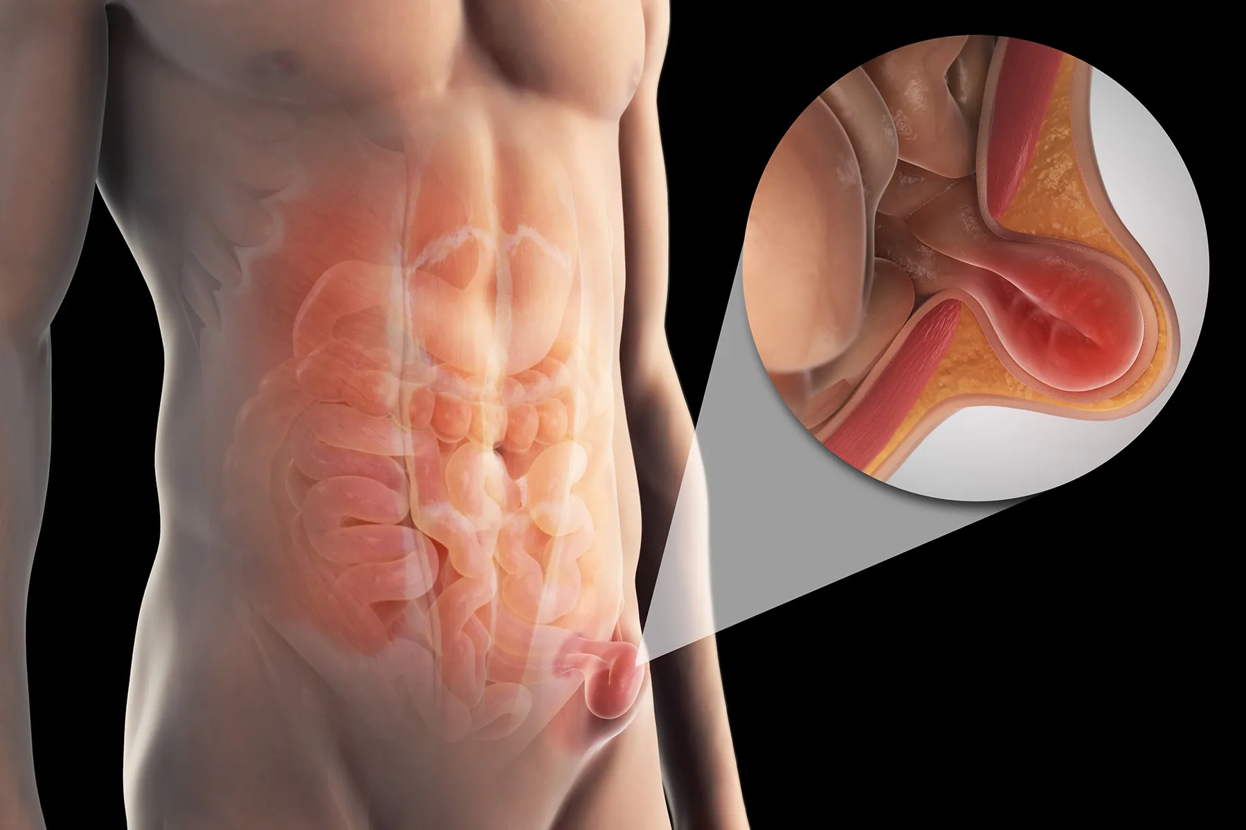 Best Inguinal Hernia Specialist & Robotic Hernia Surgeon in Delhi NCR